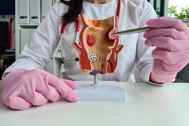 Hidup dengan Abses Anus Strategi Menghadapi dan Tips Pemulihan